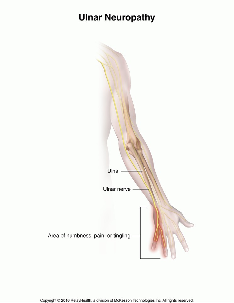 Ulnar Neuropathy: Illustration