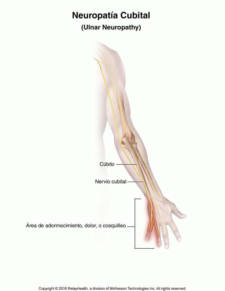 Ulnar Neuropathy: Illustration