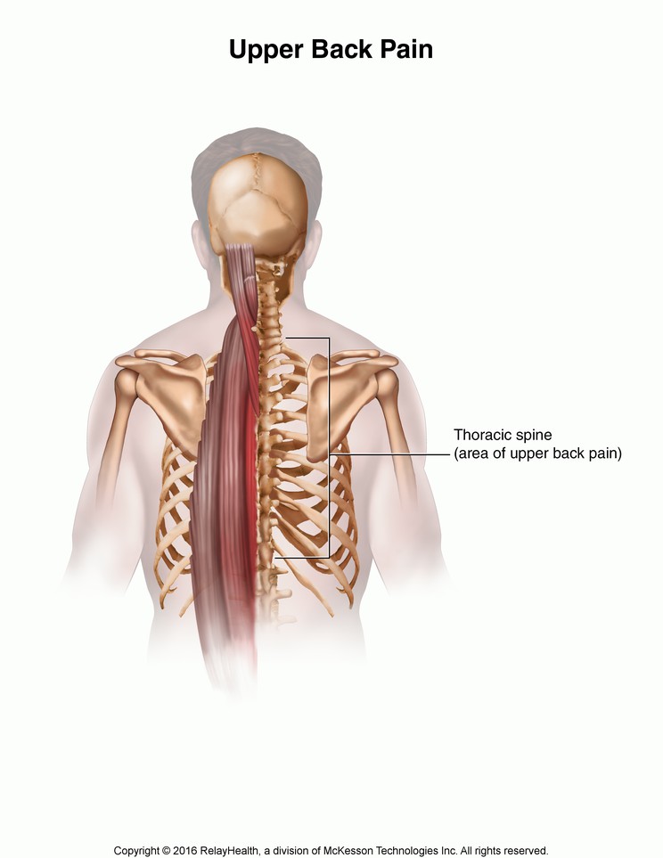 Upper Back Pain: Illustration