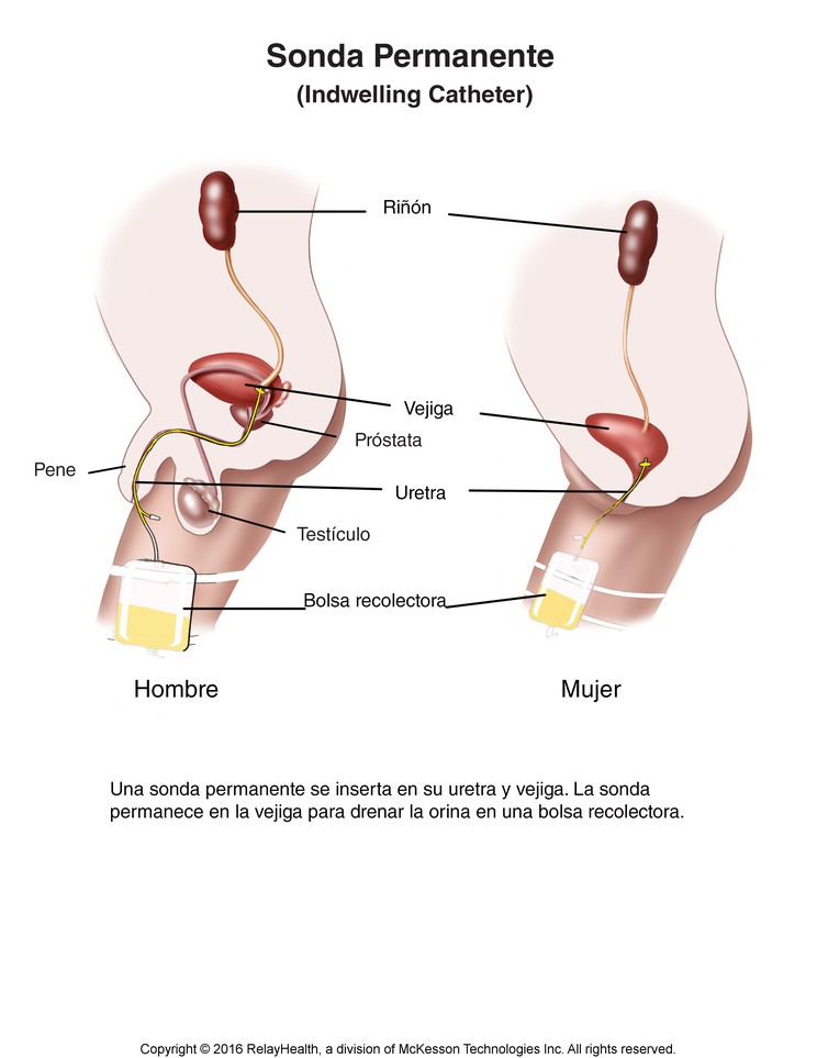 Indwelling Catheter: Illustration