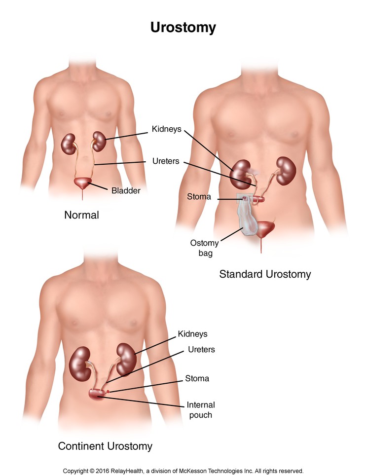 Urostomy: Illustration
