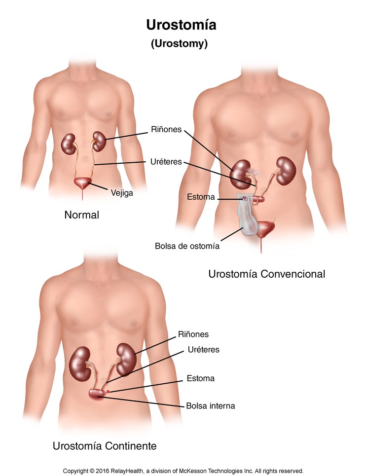 Urostomy: Illustration