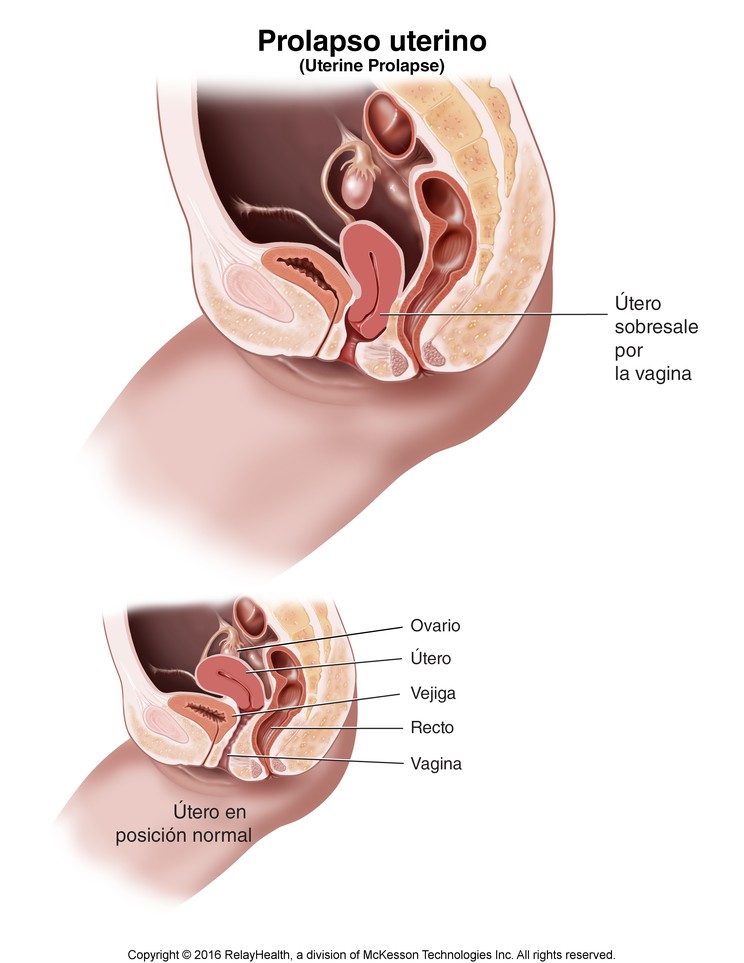 Uterine Prolapse: Illustration