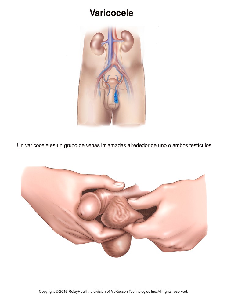Varicocele (Swollen Veins Around Testicle): Illustration