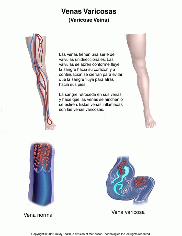 Varicose Veins: Illustration