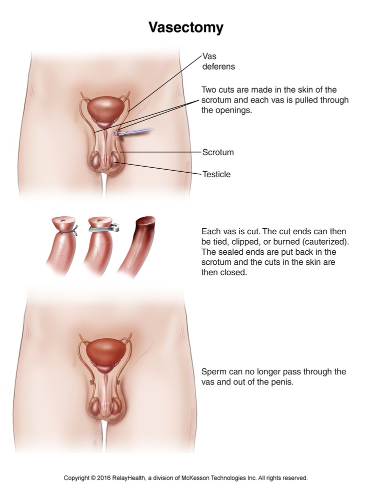 Vasectomy: Illustration