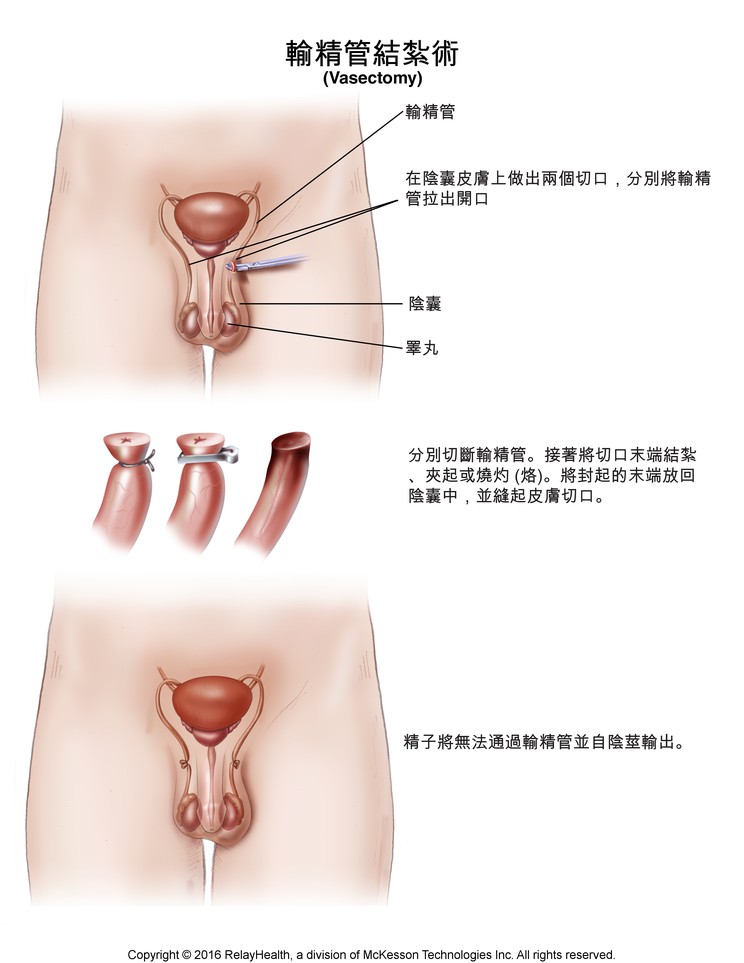 Vasectomy: Illustration