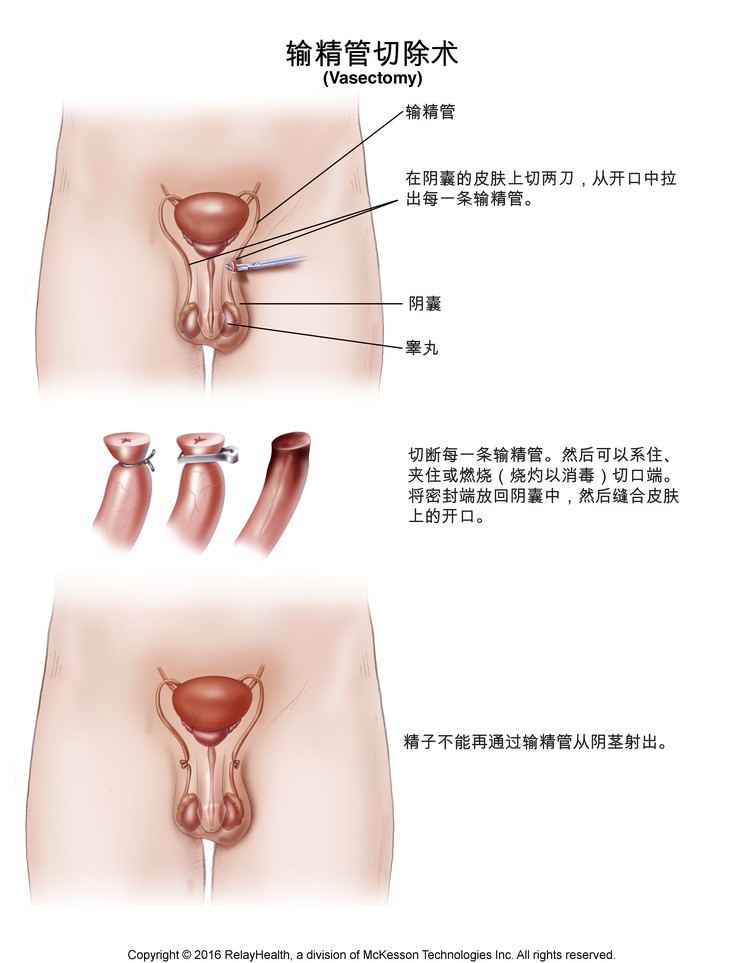 Vasectomy: Illustration