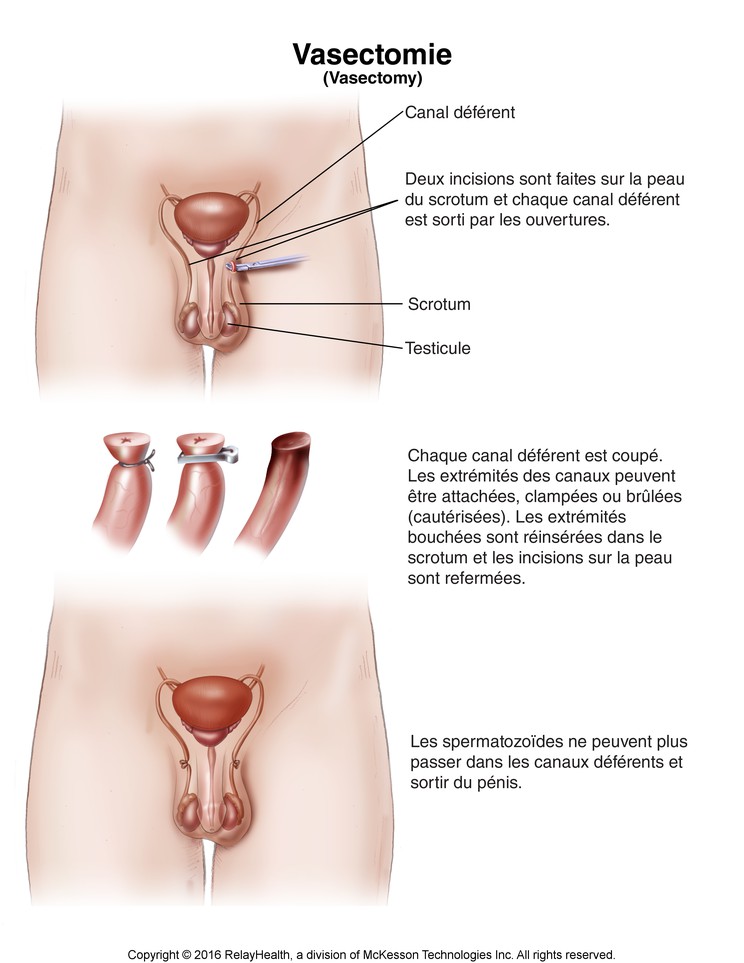 Vasectomy: Illustration