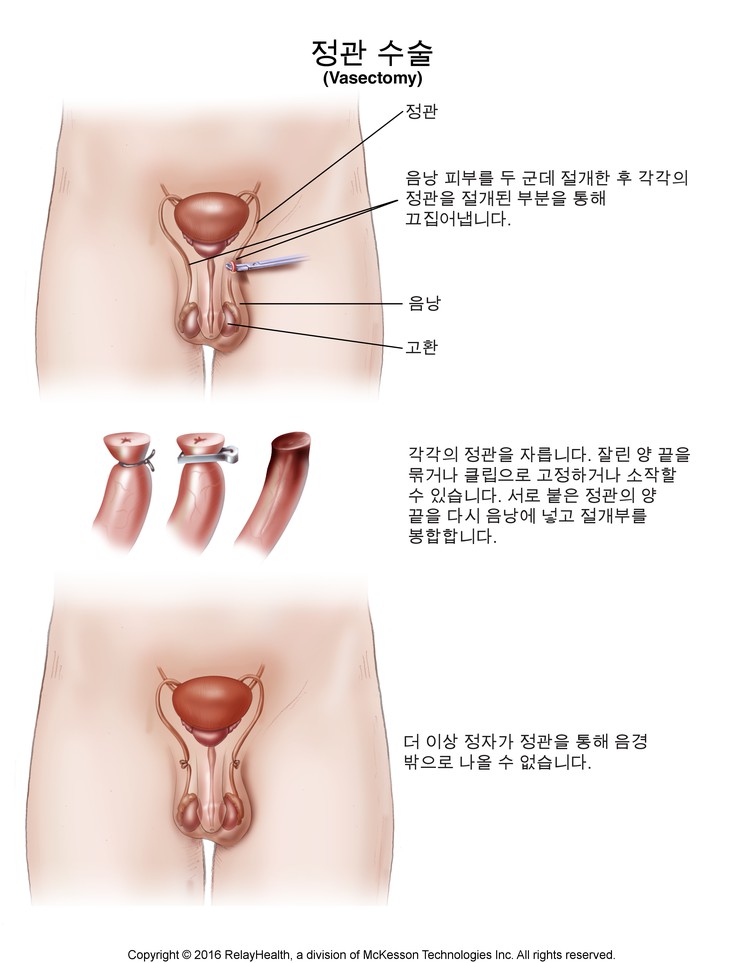 Vasectomy: Illustration