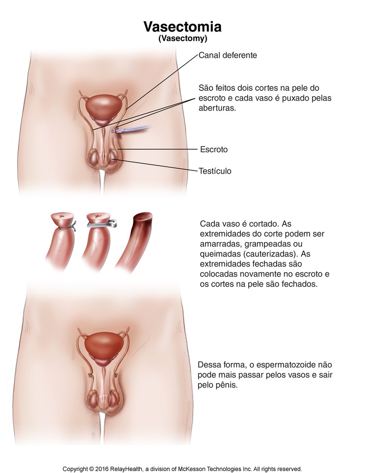 Vasectomy: Illustration