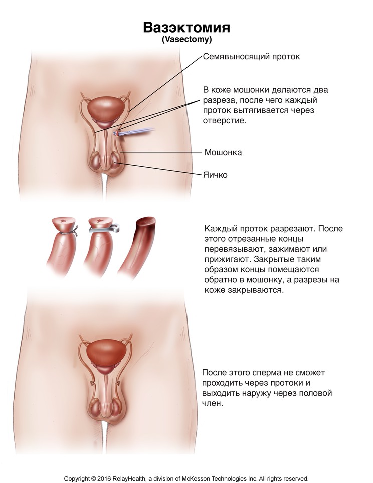 Vasectomy: Illustration