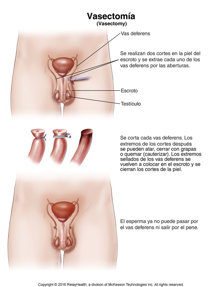 Vasectomy: Illustration