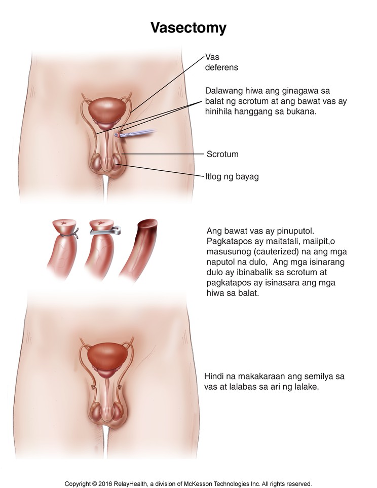 Vasectomy: Illustration