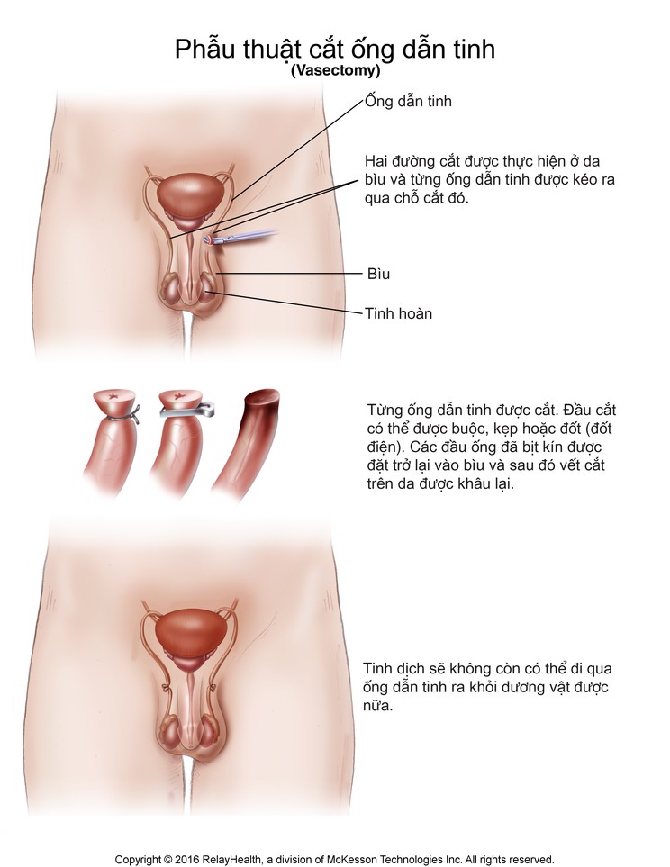 Vasectomy: Illustration