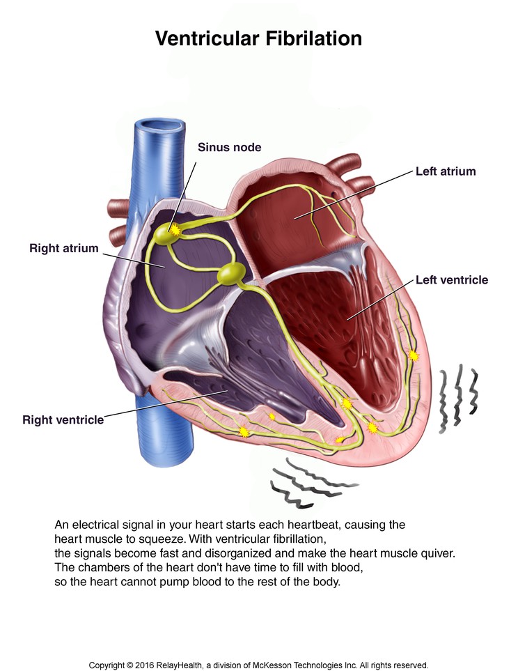 Ventricular Fibrillation: Illustration