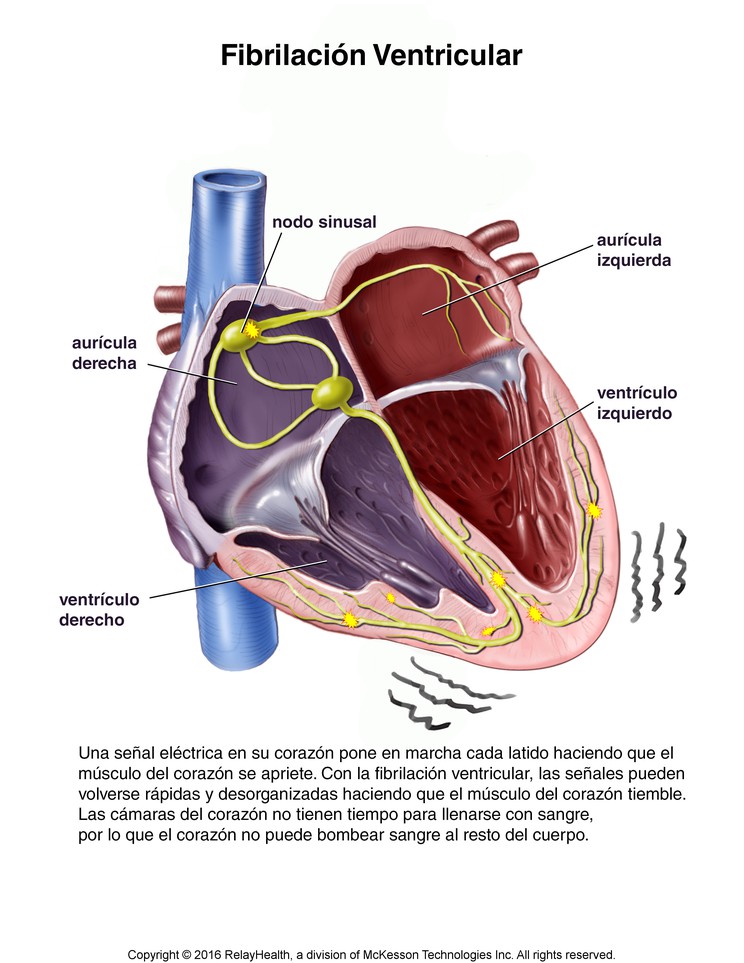 Ventricular Fibrillation: Illustration