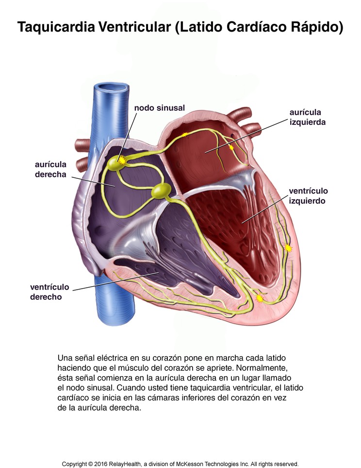 Ventricular Tachycardia (Fast Heartbeat): Illustration