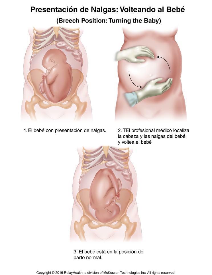Breech Position--Turning the Baby: Illustration