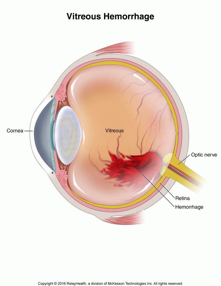 Vitreous Hemorrhage: Illustration