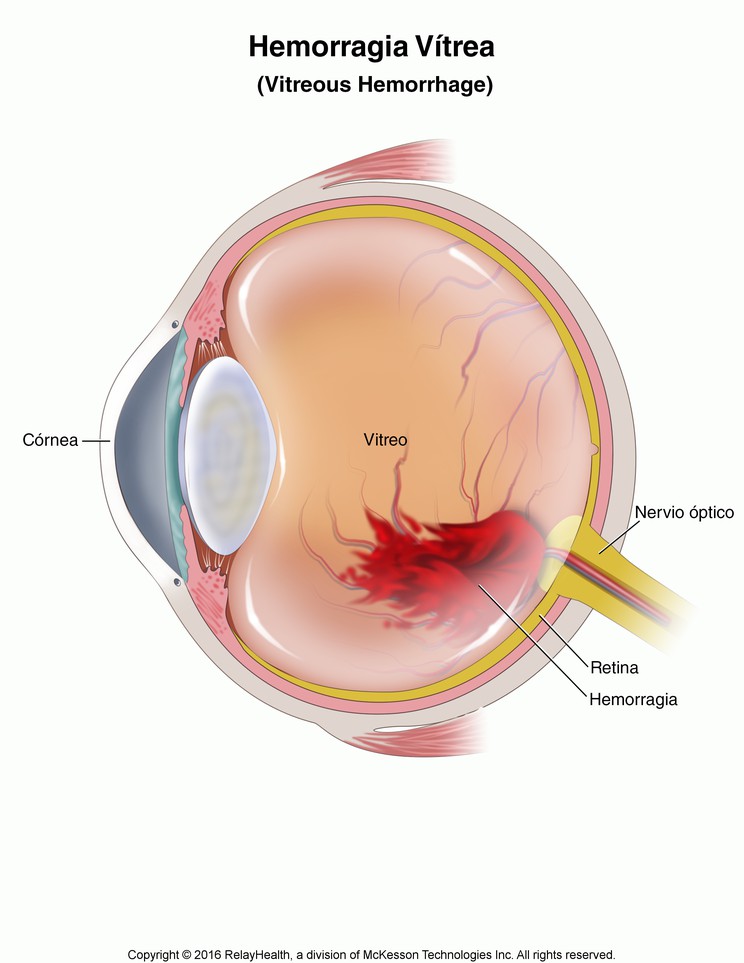 Vitreous Hemorrhage: Illustration