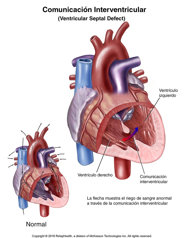 Ventricular Septal Defect: Illustration