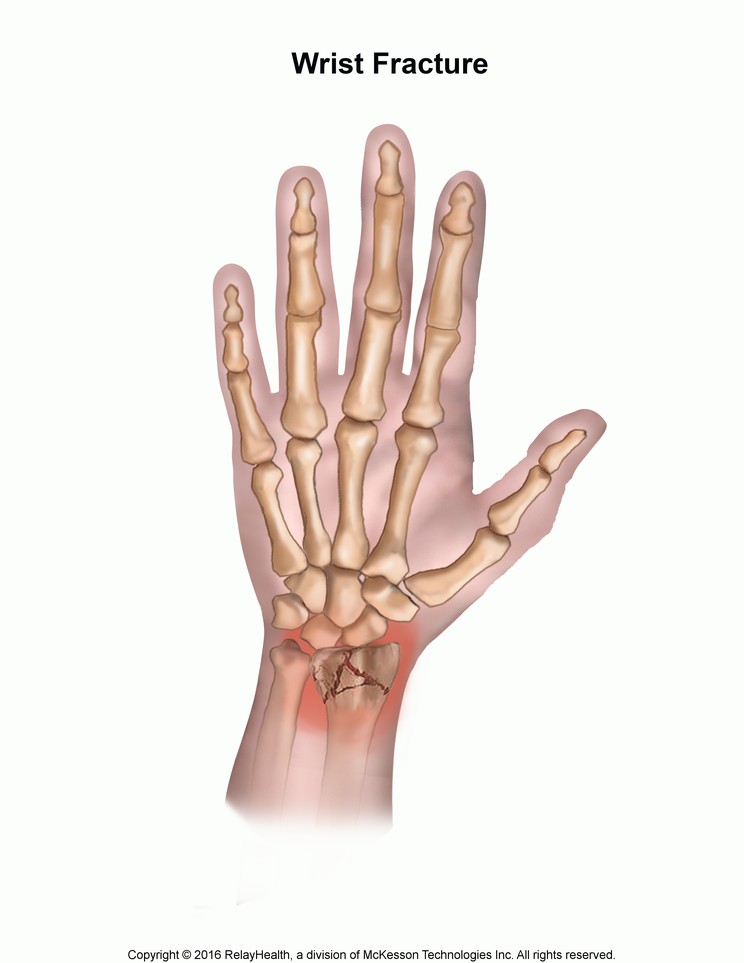 Wrist Fracture: Illustration