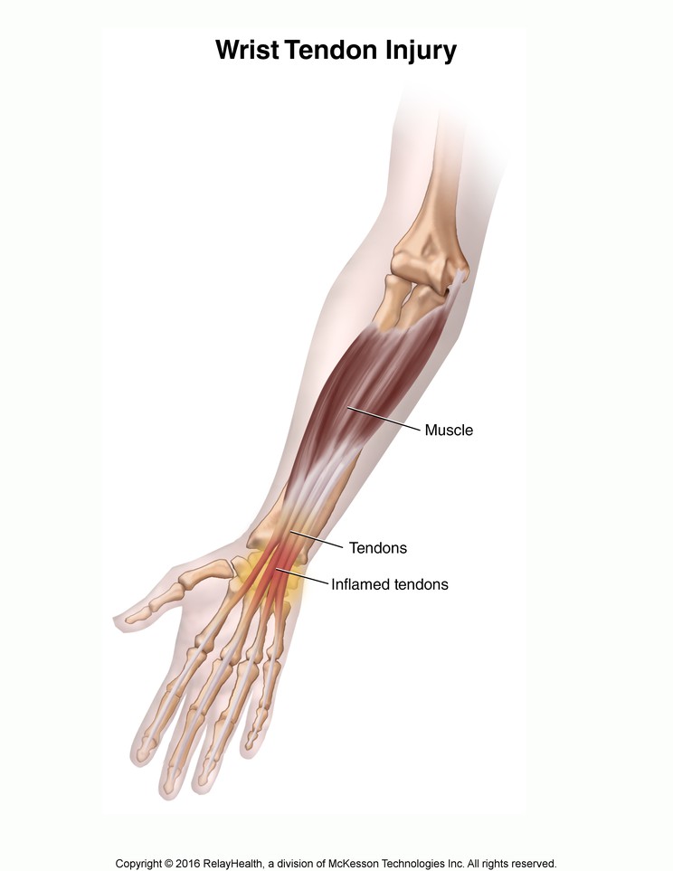 Wrist Tendon Injury: Illustration