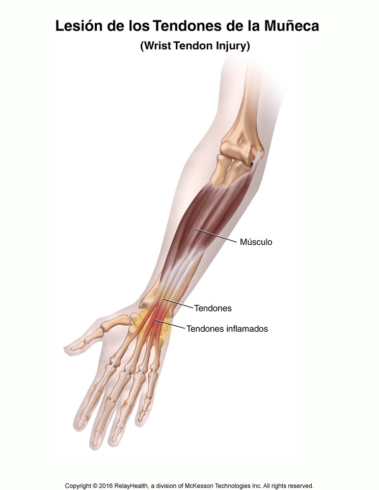 Wrist Tendon Injury: Illustration