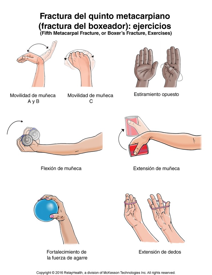 Hand Fracture: Fifth Metacarpal (Boxer's) Fracture Exercises, Illustration