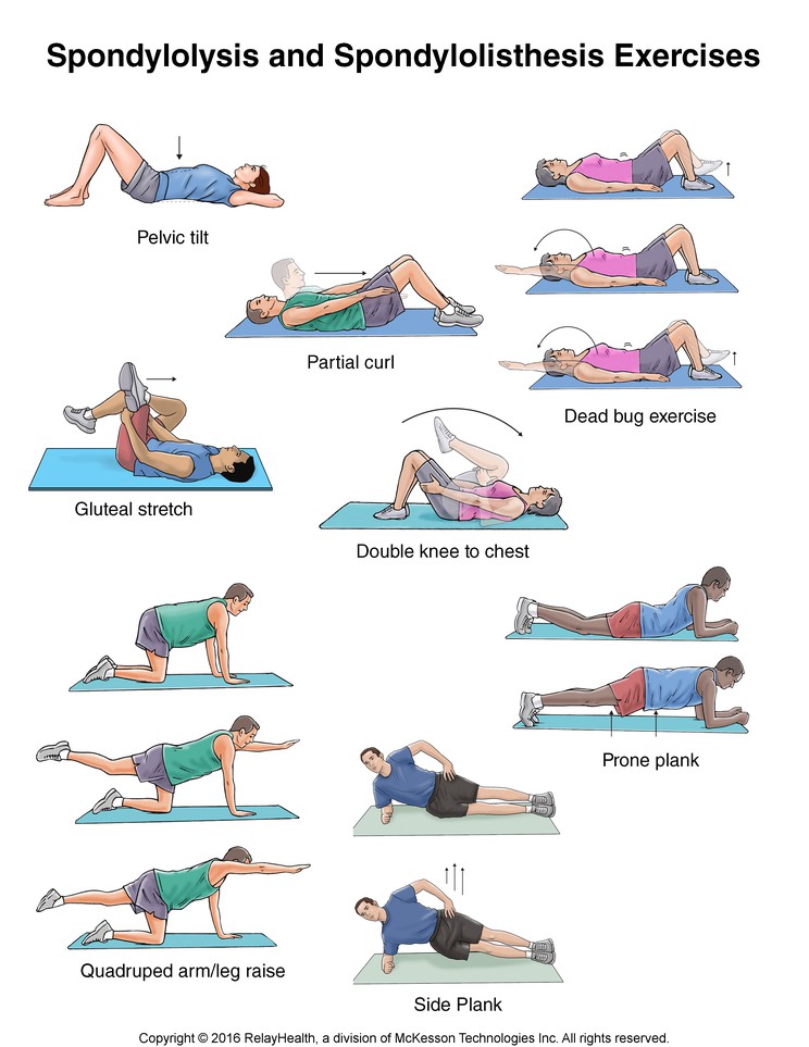 Spondylolysis and Spondylolisthesis Exercises: Illustration