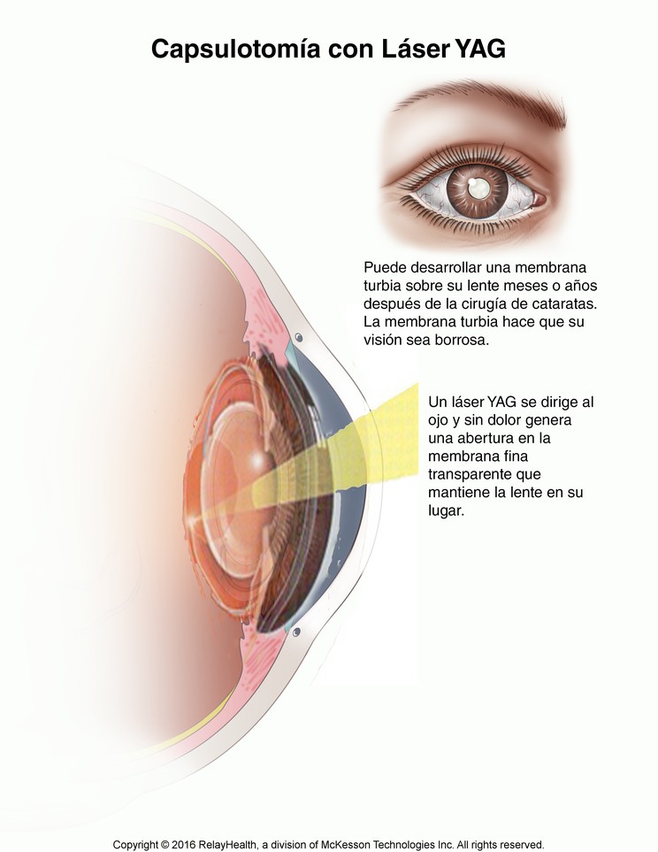 YAG Laser Capsulotomy: Illustration