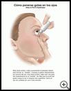Thumbnail image of: Eyedrops, How to Put in Eye: Illustration