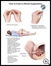 Thumbnail image of: Rectal Suppository, How to Insert: Illustration