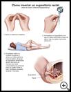 Thumbnail image of: Rectal Suppository, How to Insert: Illustration