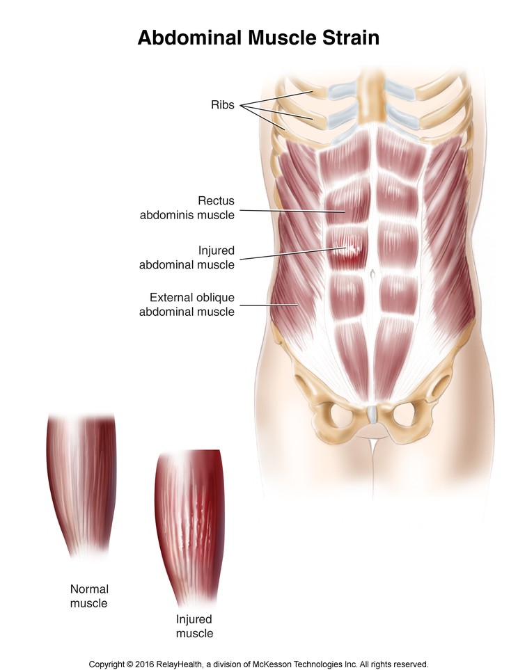 Abdominal Muscle Strain: Illustration