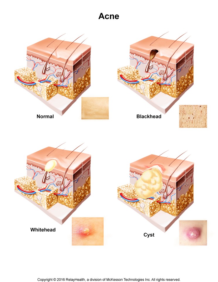 Acne: Illustration