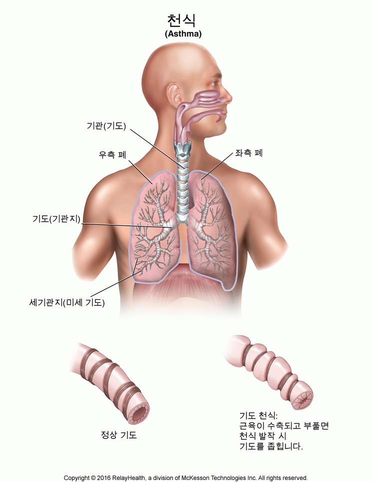 Asthma: Illustration
