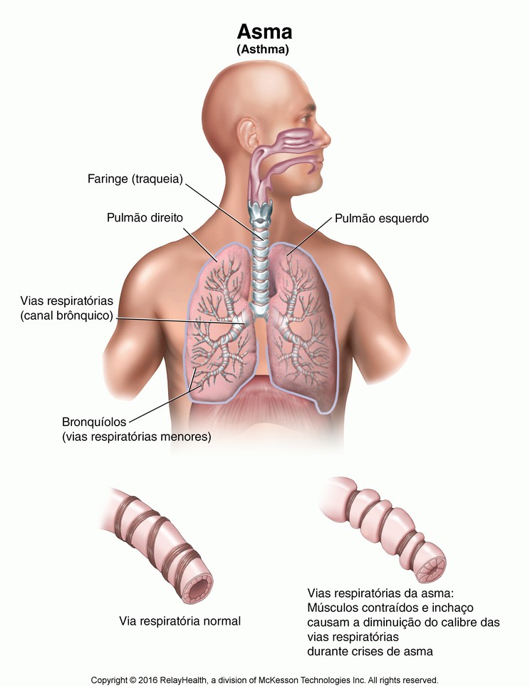 Asthma: Illustration