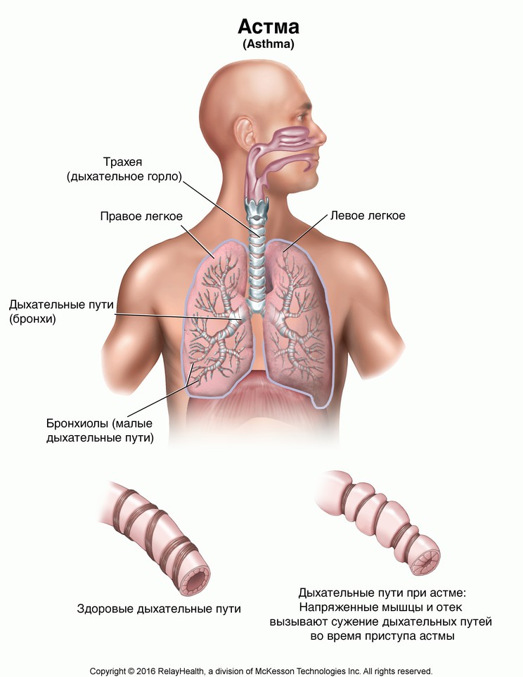 Asthma: Illustration