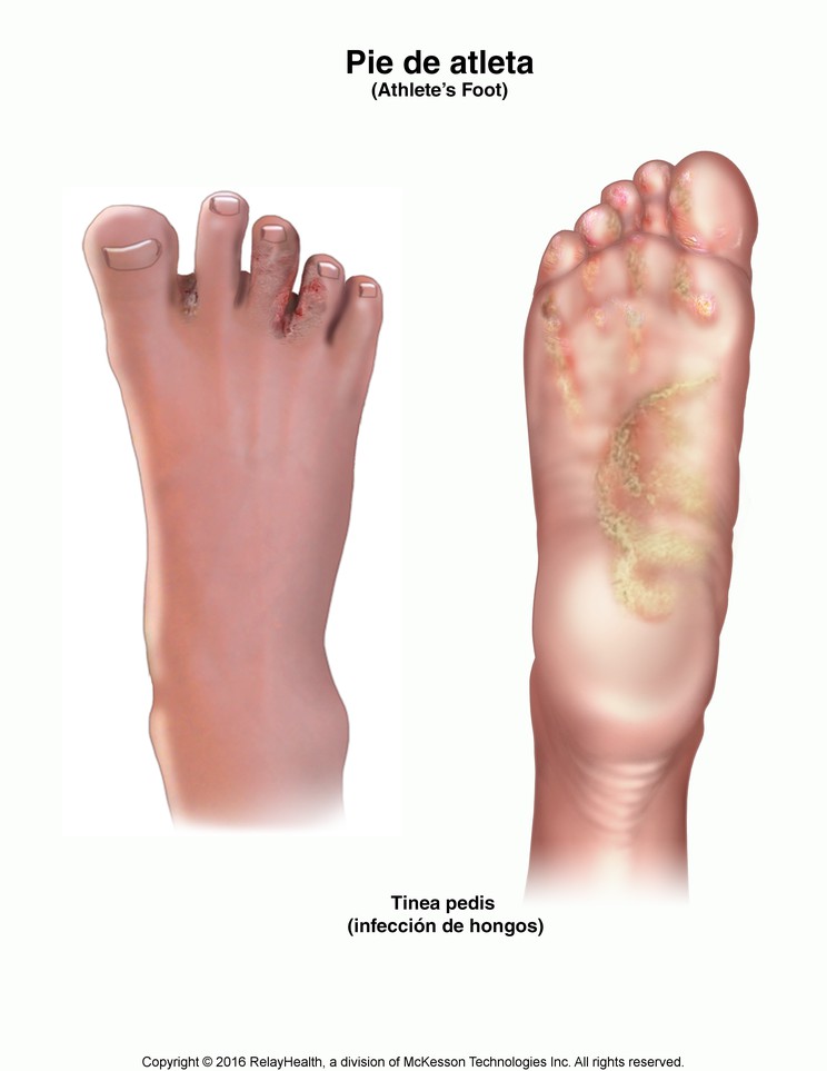 Athlete's Foot: Illustration