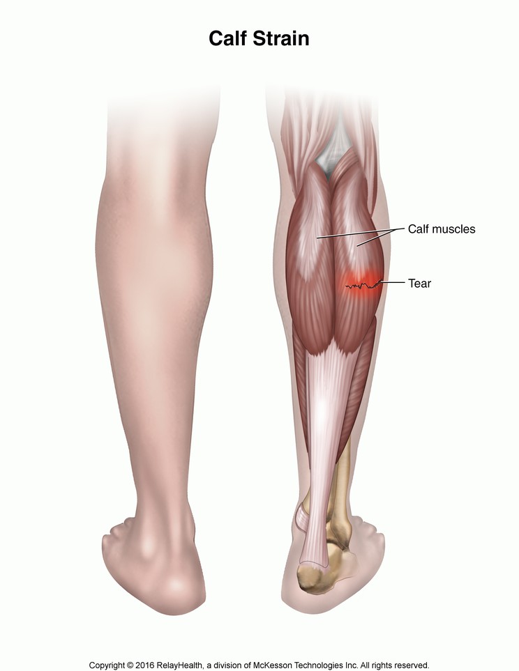 Calf Strain: Illustration