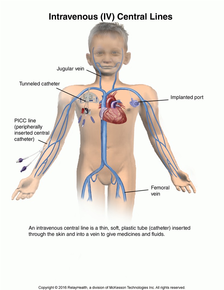 Intravenous (IV) Central Lines: Illustration