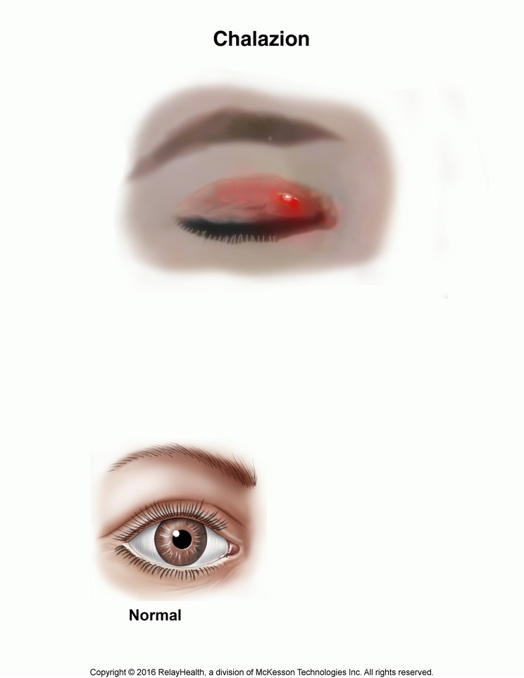 Chalazion: Illustration