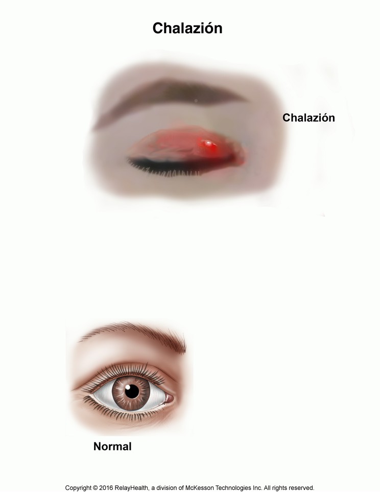 Chalazion: Illustration
