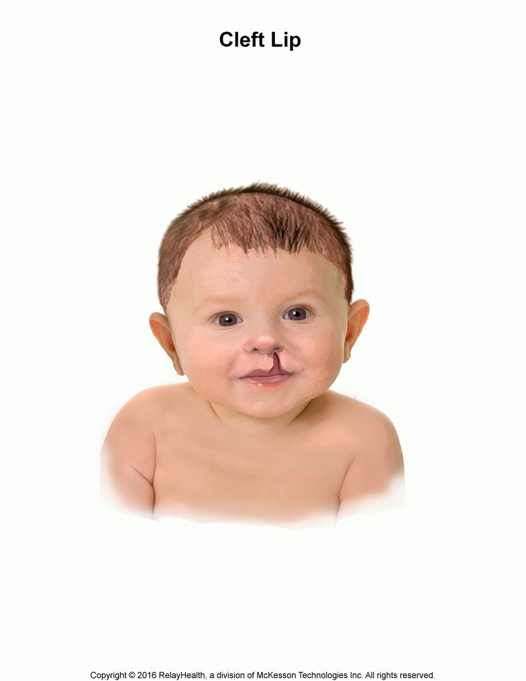 Cleft Lip: Illustration