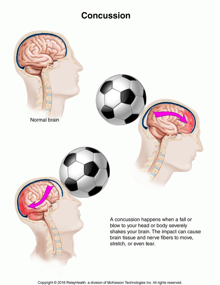 Concussion: Illustration