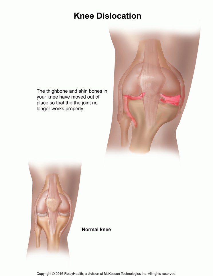 Dislocated Knee: Illustration