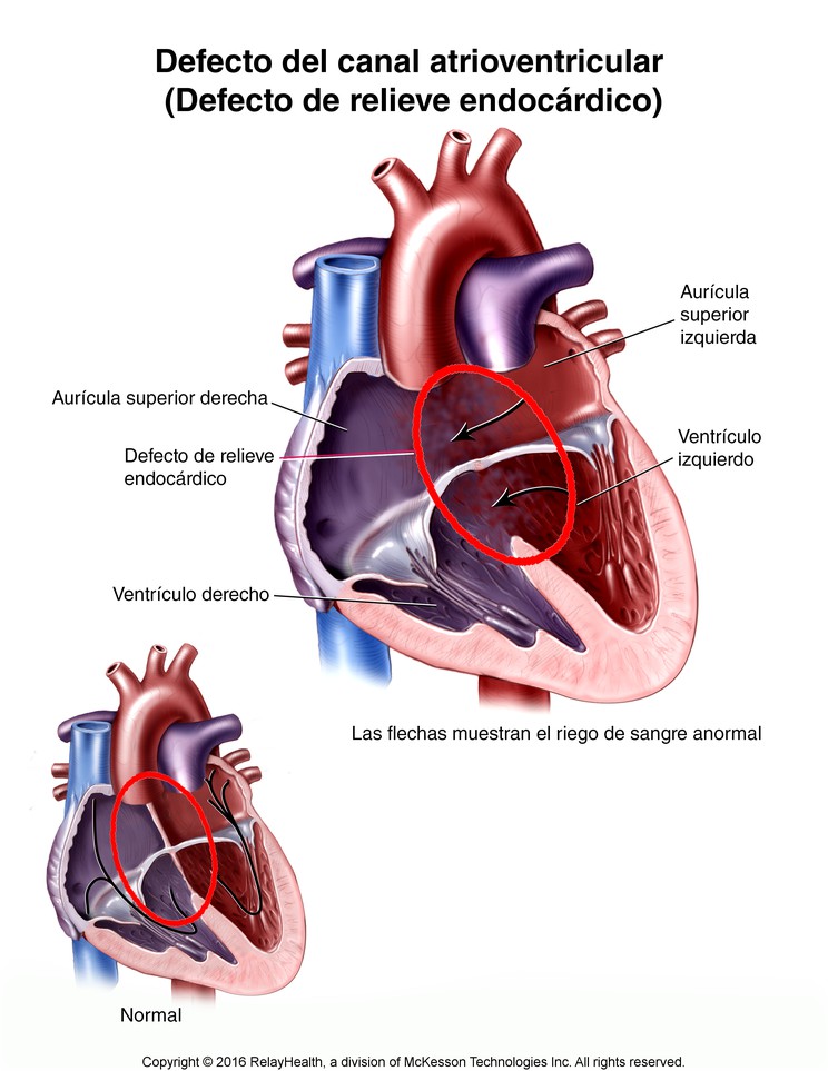 Endocardial Cushion Defect: Illustration