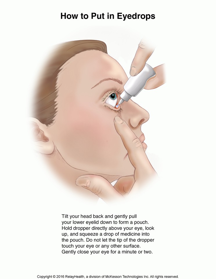 Eyedrops, How to Put in Eye: Illustration